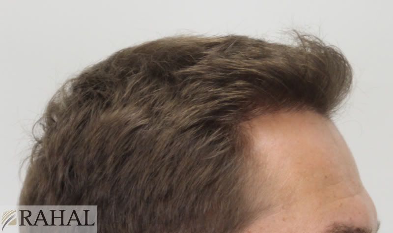 Serie per risposte di ricostruzione di capelli